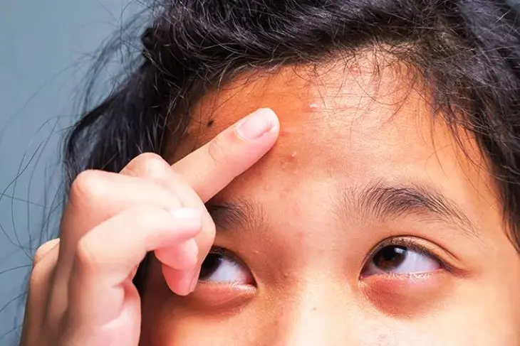 Bruntusan di Dahi? Ini Penyebab dan Cara Mengatasinya