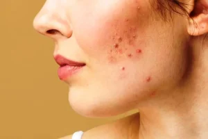 Hati-Hati! Salah Eksfoliasi Justru Bikin Bruntusan Makin Parah