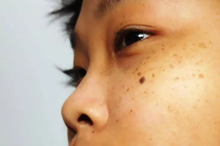 5 Penyebab Utama Flek Hitam di Wajah yang Sering Diabaikan