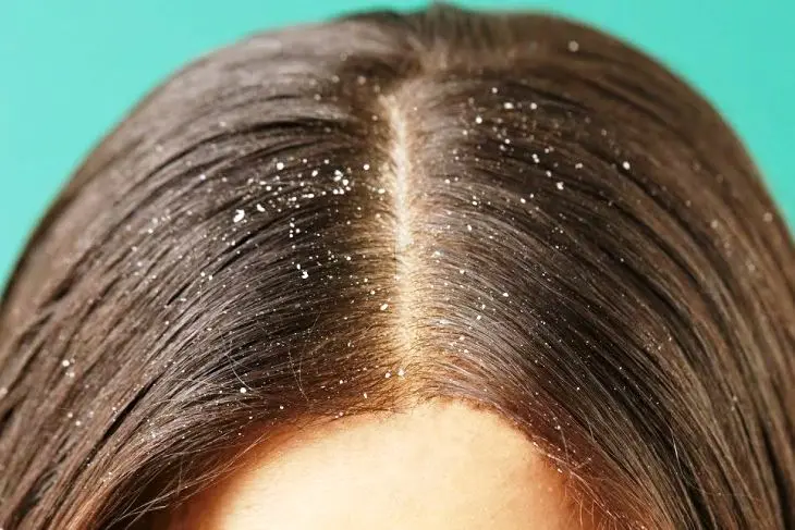 Ketombe Basah vs Kering: Kenali Perbedaan dan Cara Mengatasinya