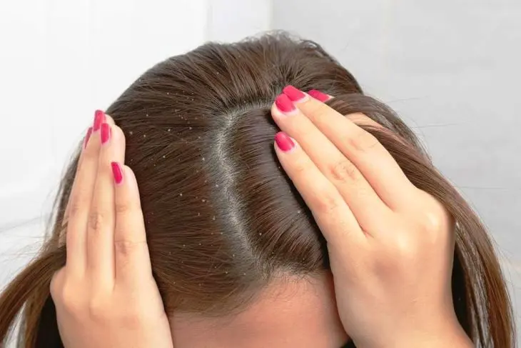 10 Shampoo Anti Ketombe Terbaik yang Terbukti Ampuh