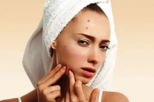 Skincare Routine Anti-Komedo: Panduan Lengkap untuk Kulit Bersih